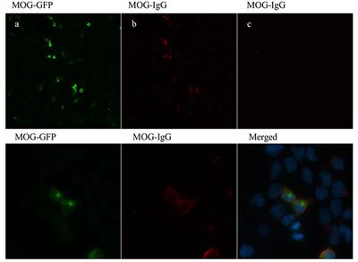 Brain Atrophy in Relapsing Optic Neuritis Is Associated With Crion Phenotype